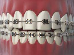 Metal Braces