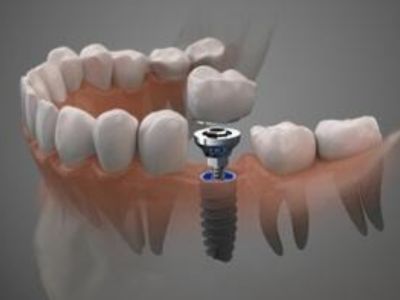 dental-implants