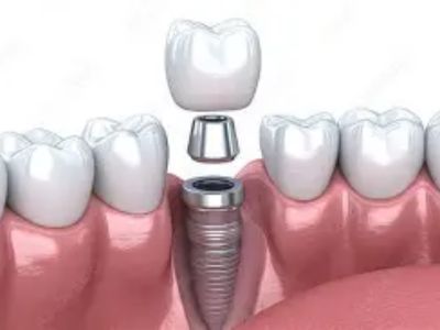 dental-implants
